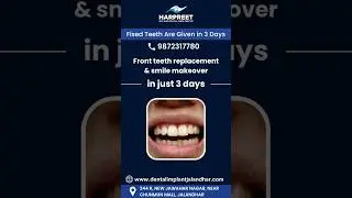 Front Teeth Replacement In 3 Days #shortsvideo #shortsyoutube #shorts #shortsfeed #shortsviral
