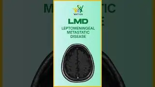 🧠 Understanding Leptomeningeal Metastatic Disease (LMD)
