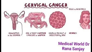 Cervical Cancers for man & Women's