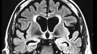 Mesial Temporal Sclerosis