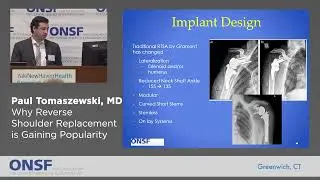 Paul Tomaszewski, MD -  Why Reverse Shoulder Replacement is Gaining Popularity