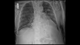 Imaging of Cardiac Support Devices