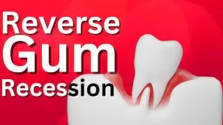 6 Natural Remedies for Gum Recession