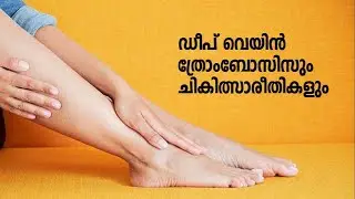 Deep Vein Thrombosis (DVT) and its Treatments | HEALTH TALKS