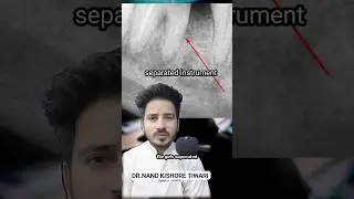 HOW i RETRIEVE Broken File From MANDIBULAR MOLAR  #rootcanaltreatment  #dentalprocedure #shorts