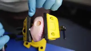 The Cartilage procedure ProChondrix Surgical Technique Overview