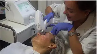 Review of Tixel skin resurfacing treatment for wrinkles and sagging eyelids