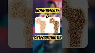 Menopause & Osteoarthritis | Female Health | Apvaad Clips #shorts
