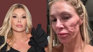 &ldquo;Real Housewives&rdquo; alum Brandi Glanville burns face trying to kill parasite with beauty hack: 'I over
