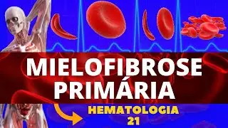 MIELOFIBROSE (TUDO SOBRE MIELOFIBROSE) - HEMATOLOGIA