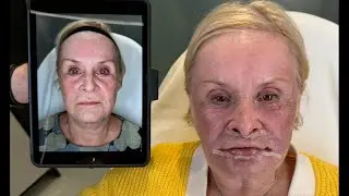 LIP LIFT + TCA PEEL + FILLERS - DAY 1 POST OP| Dr. Jason Emer