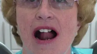 Patient fitting her upper chrome cobalt based denture.