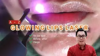 Glowing Lips Laser | Before After & A-Z Laser Bibir dr. Irfan Prasetya