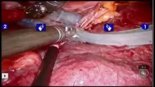 AfibAblation