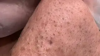 Skin Savvy: Blackhead Removal / With Extractions & Extended Skincare Routine (Full Process)