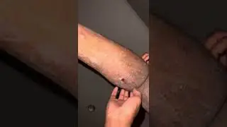 Scratching of eczema with lid