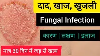 दाद, खाज के कारण और इलाज | Fungal infection Treatment | #youtubevideo #kamlapharmacy #fungal #viral 