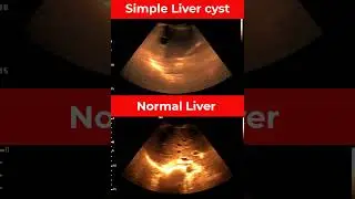Simple Liver Cyst | #shorts