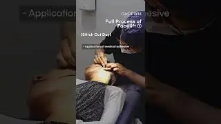 Full Process of Facelift 7 #facelift #facelifting #DrKwakMinho #dasipium #PostOpCare #stitchout