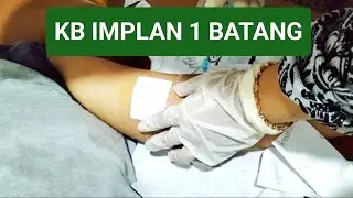 PEMASANGAN KB IMPLAN 1 BATANG 2024