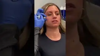 Before & After Filler