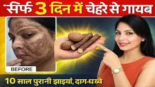 त्वचा की मुश्किल समस्या जैसे DARK SPOTS और HYPER PIGMENTATION का 100% इलाज़ सिर्फ 1 हफ्ते में💕