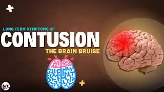 Brain Contusion/Concussion in 2 minutes| Prevention & long-term effects || EP#25