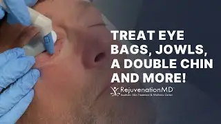 Agnes RF: Your Solution for Under Eye Bags