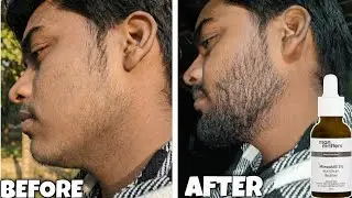 Minoxidil Ne Meri Beard Barbaad Kar Di&hellip; Kyun ? minoxidil beard growth mistake | minoxidil beard 2026