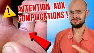 Mycose entre les orteils : pourquoi s'en m&eacute;fier ?