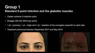 The One21 technique: An individualized treatment for glabellar lines - Video abstract [ID 281901]
