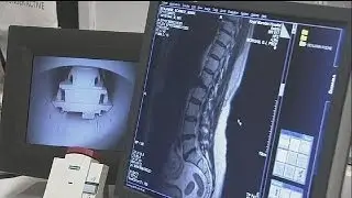 New MRI scan redefining myeloma treatment
