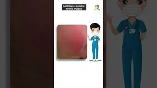 Enfermedades exantem&aacute;ticas en pediatr&iacute;a parte 2: Eritema infeccioso. #medicos #medicinageneral