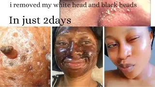 Shocking results 😳How I removed my Whiteheads/wrinkles instantly #diy #clearskin