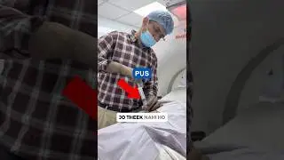 Back Pain ठीक नहीं हुआ? MRI में निकला Spine TB 😱 #shorts
