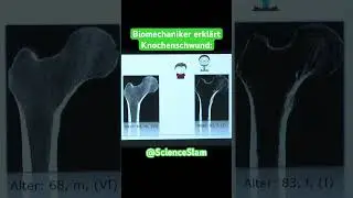 Osteoporose (Knochenschwund) aus der Sicht eines Biomechanikers #scienceslam #ingenieur