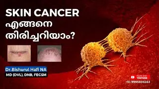 Skin cancer എങ്ങനെ തിരിച്ചറിയാം? Dr Bishurul Hafi MD