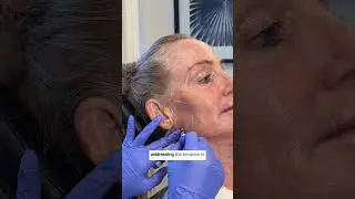 How cheek filler can age you!