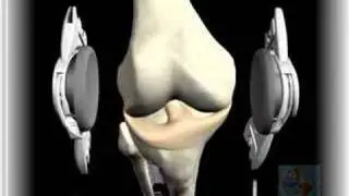 Gen II Knee