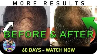 Onion Juice Hair Regrowth - New Pics - 60 Days Before & After Results!