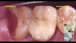 Case Discussion 2 - DME 7mm in LAST TOOTH  (Deep Margin Elevation)