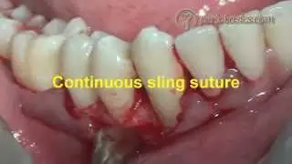 Continuous sling suture