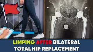LIMPING after TOTAL HIP REPLACEMENT SURGERY !! #totalhipreplacement #hipreplacementsurgery  