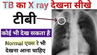 TB का x ray देखना सीखे - एक्स रे में टीबी कैसे देखते है - X ray report normal and TB