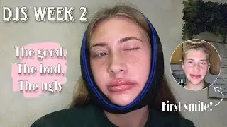 Week 2 Post-Op | DOUBLE JAW SURGERY | pain, movement progression, & staying active