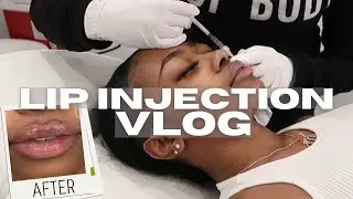 COME GET LIP FILLER WITH ME VLOG + FULL EXPERIENCE | XOMVGGIE