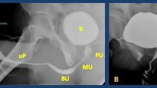 Intravenous urography vs retrograde urethrography vs micturating urethrography details 
