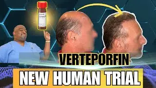 New Verteporfin Trial By Dr. Bisanga *WILL THIS CURE HAIR LOSS