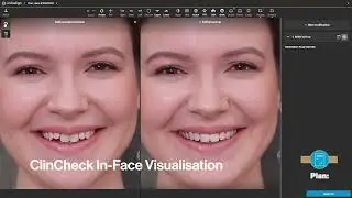The Align&trade; Digital Experience | Align Technology Invisalign&reg; | iTero&trade;