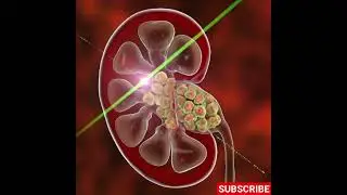 How Your Body Creates a Kidney Stone (3D Animation)